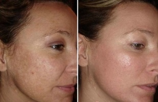 fotoğraflardan önce ve sonra lazerle yüz cildi gençleştirme